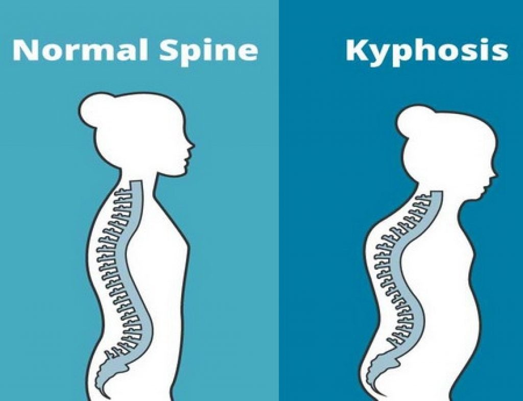 Painful Kyphosis and a Forward Head - Perfect Posture